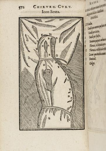 Bok - Skoklosters slott - 102623.tif author Tagliacozzi Gaspare; sv Den italienske kirurgen Gaspare Tagliacozzis illustrerade skrift som redogör för metoder att utföra hudtransplantation för att återskapa näsor öron och läppar ...